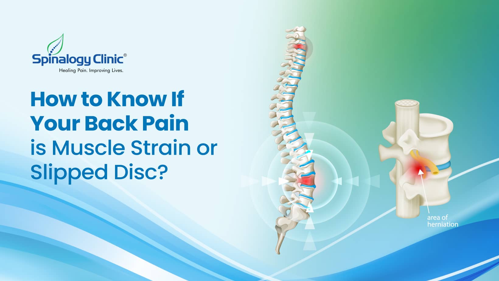 How to Know If Your Back Pain is Muscle Strain or a Slipped Disc?